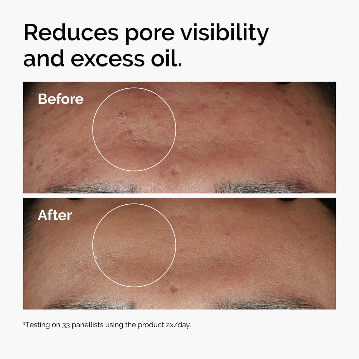 niacinamide-10-zinc-1-v5 ord-niacinamide-zinc-blemish-serum-before-after-pores.jpg