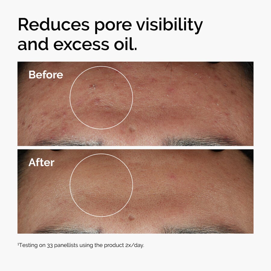 niacinamide-10-zinc-1-v5 ord-niacinamide-zinc-blemish-serum-before-after-pores.jpg