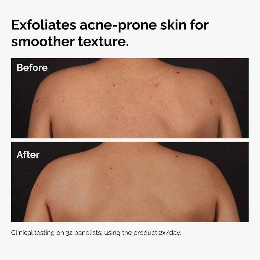 salicylic-acid-0-5-body-serum-s6 ord-salicylic-acid-body-serum-before-after-graphic-NA.jpg