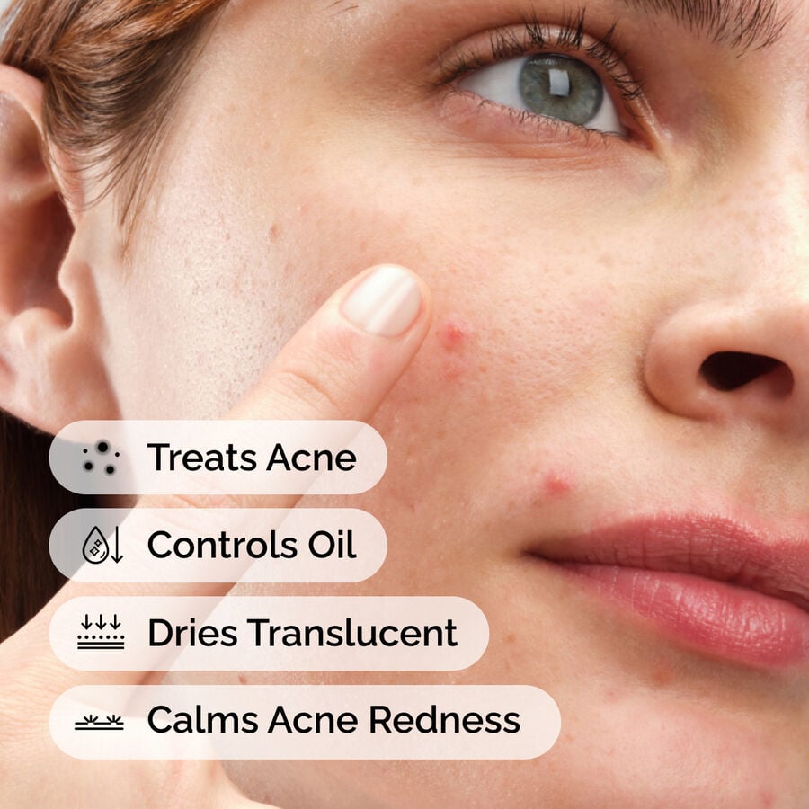sulfur-10-powder-to-cream-concentrate-w9 ord-sulfur-10pct-powder-to-cream-concentrate-model-application-with-benefits-acne.jpg